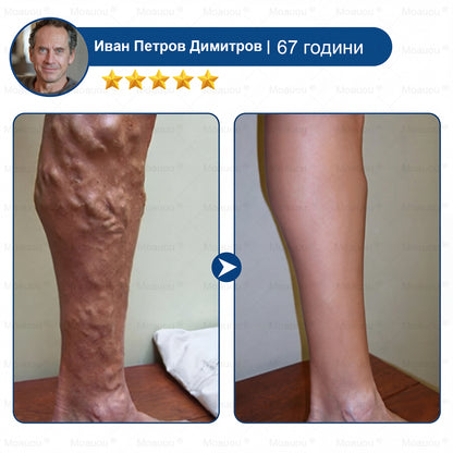 🧬✅Moauou® GHK-Cu Микроиглен регенериращ пластир –  по-малко подуване, по-леки крака и по-малко видими вени още в рамките на 7–14 дни⚡