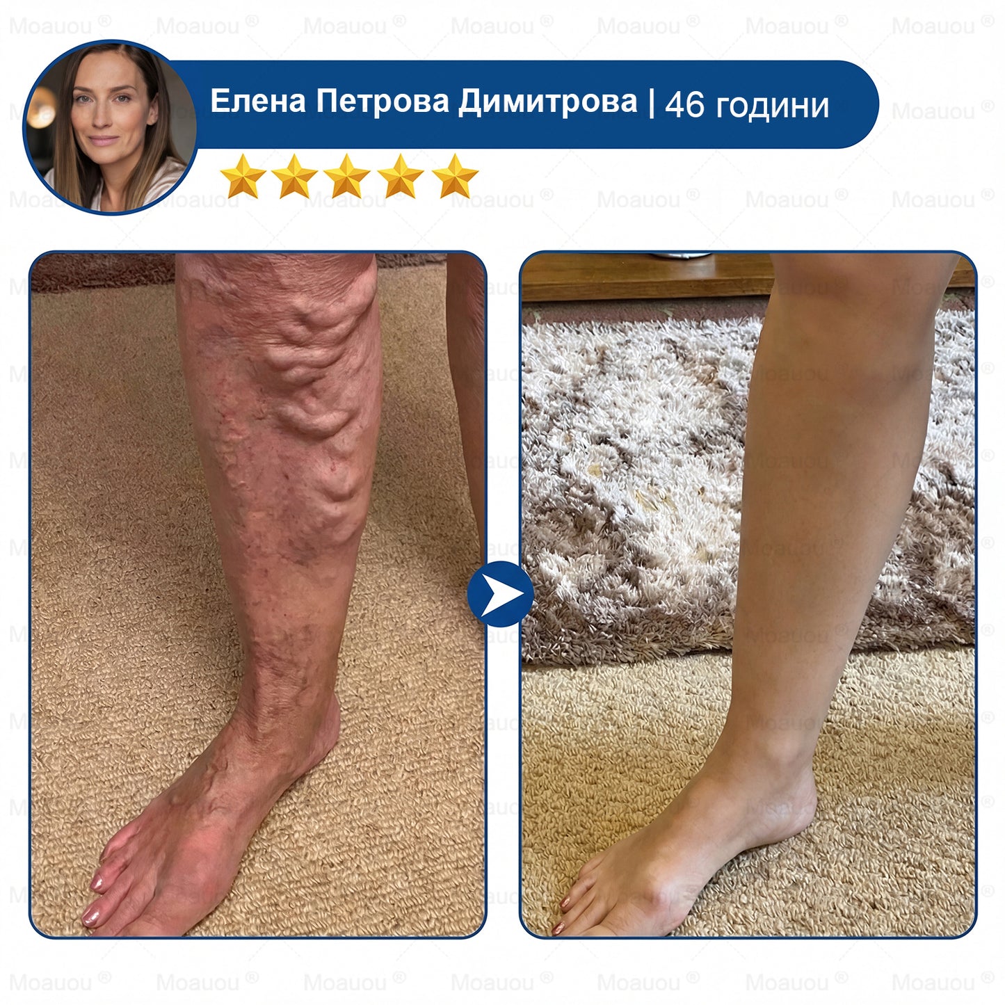 🧬✅Moauou® GHK-Cu Микроиглен регенериращ пластир –  по-малко подуване, по-леки крака и по-малко видими вени още в рамките на 7–14 дни⚡