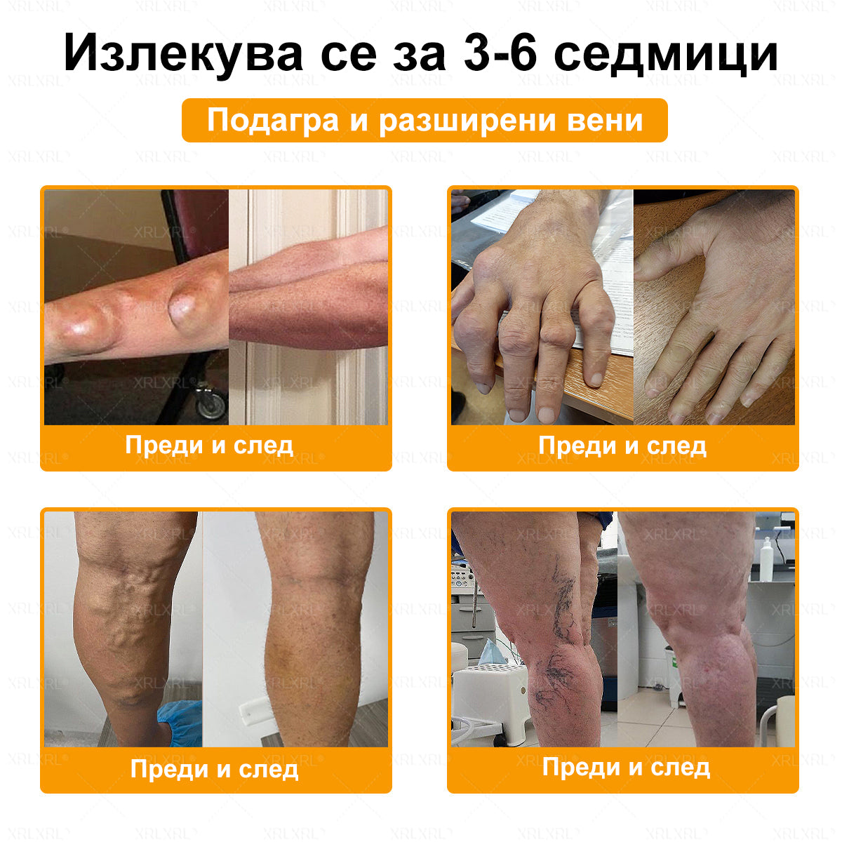 ✨✨𝑋𝑅𝐿𝑋𝑅𝐿® Болеутолителен крем с пчели яд и лечение на кости (Специално за възрастни хора и препоръчан от PTOT)
