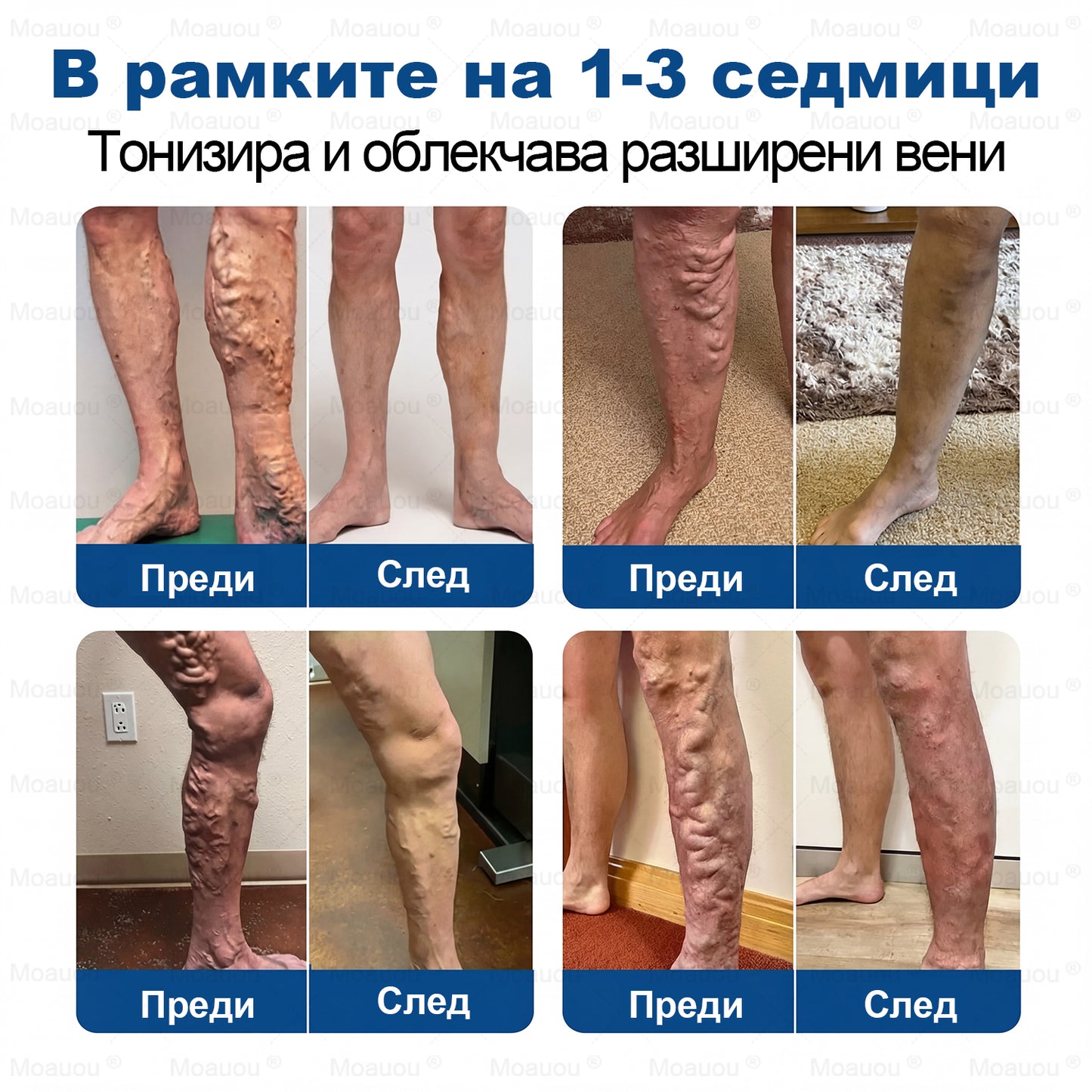 🧬✅Moauou® GHK-Cu Микроиглен регенериращ пластир –  по-малко подуване, по-леки крака и по-малко видими вени още в рамките на 7–14 дни⚡