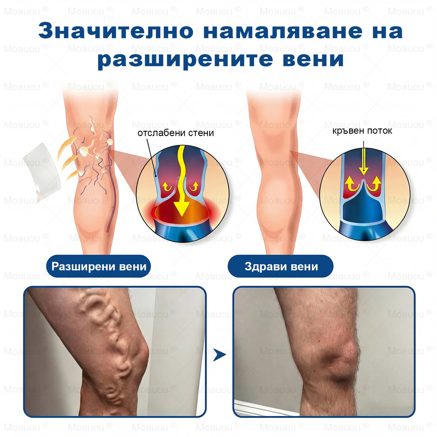 🧬✅Moauou® GHK-Cu Микроиглен регенериращ пластир –  по-малко подуване, по-леки крака и по-малко видими вени още в рамките на 7–14 дни⚡